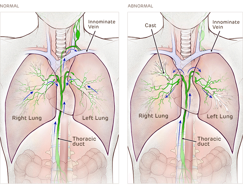 Normal and Abnormal Lymphatic System - Plastic Bronchitis