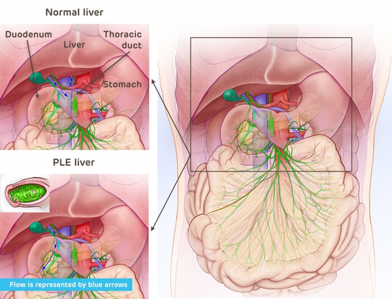 Diagram Protein-Losing Enteropathy Liver