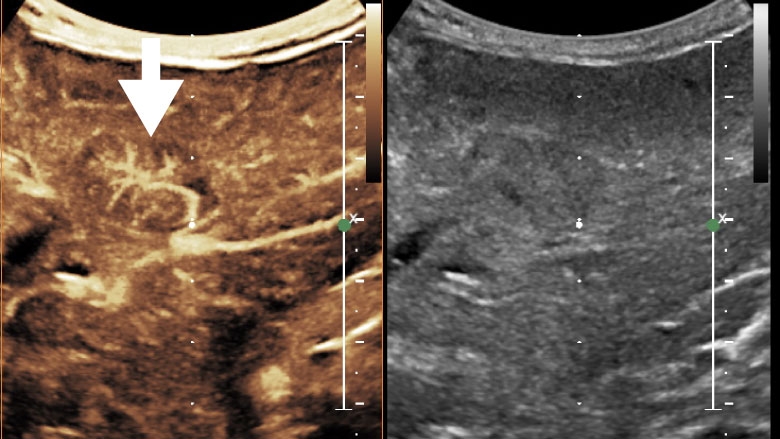 Contrast-enhanced ultrasound (CEUS) of the liver demonstrating a spoke-wheel arterial pattern in the lesion compatible with a focal nodular hyperplasia.