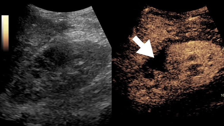 A contrast-enhanced ultrasound (CEUS) of the right kidney in a teenage boy following blunt abdominal trauma during sports. The arrow shows a focal region of no blood flow within the kidney compatible with traumatic injury.