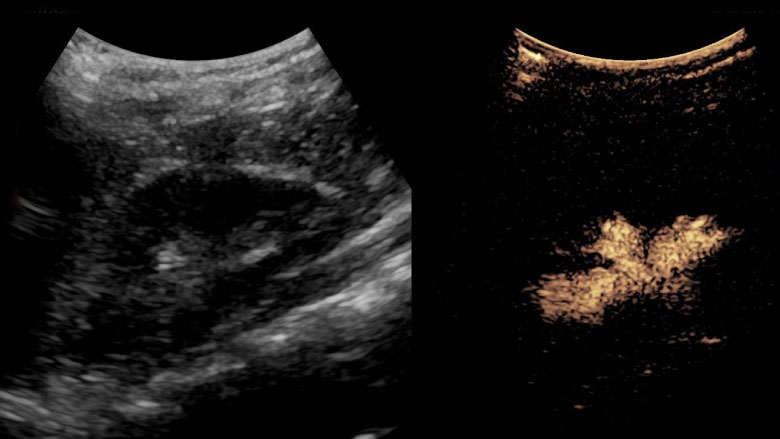 Ultrasound showing contrast-enhanced voiding urosonography (ceVUS) demonstrating vesicoureteral reflux in the left kidney presented in a dual mode