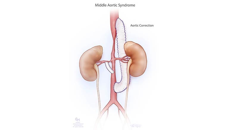 Middle Aortic PostOp
