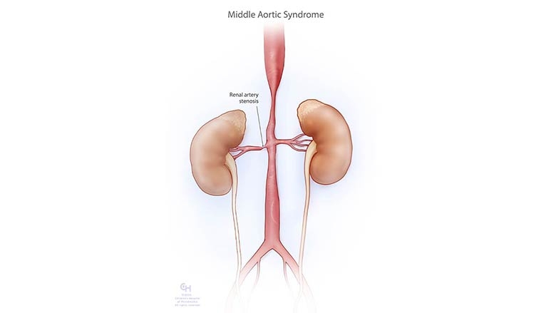 Middle aortic syndrome/aortic coarctation