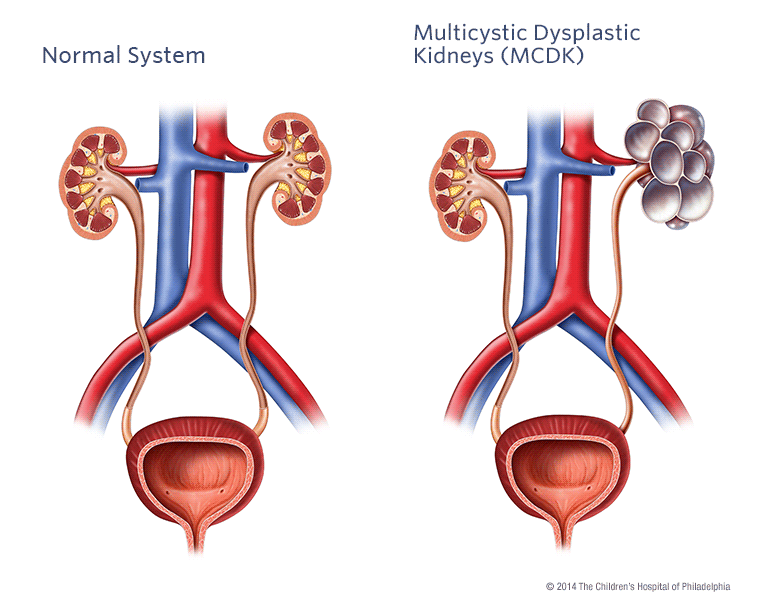 Multicystic Dysplastic Kidney Illustration