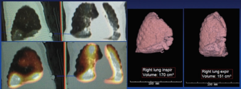Nuclear Perfusion Scan and CT Angiogram with 3-D Reconstruction of Right Lung