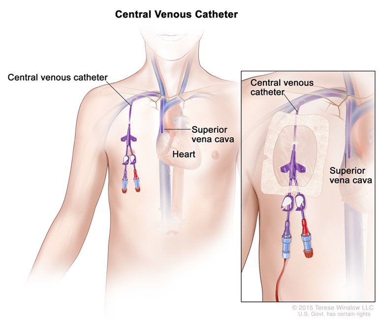 central venous catheter illustration