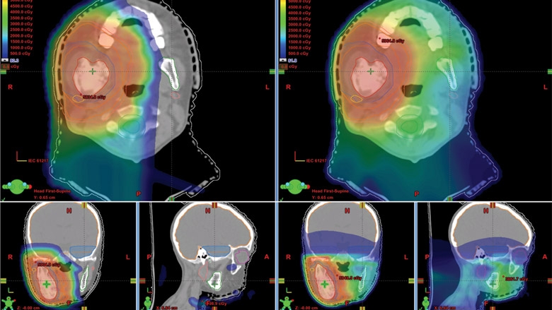 patient with proton therapy