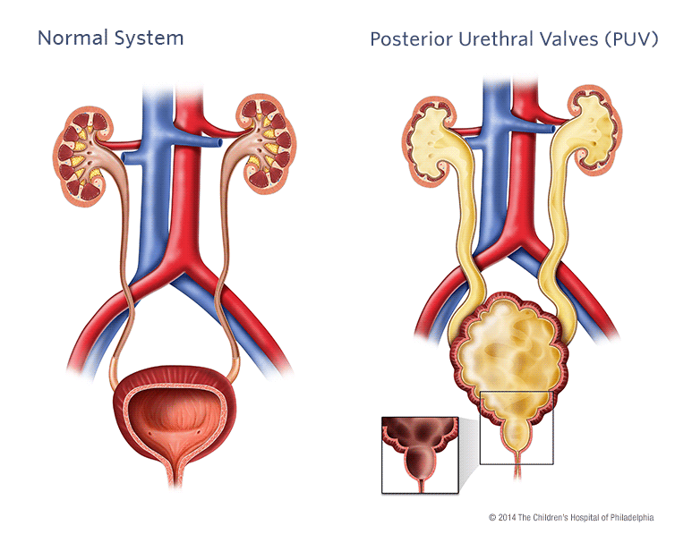 Posterior Urethral Valves Illustration
