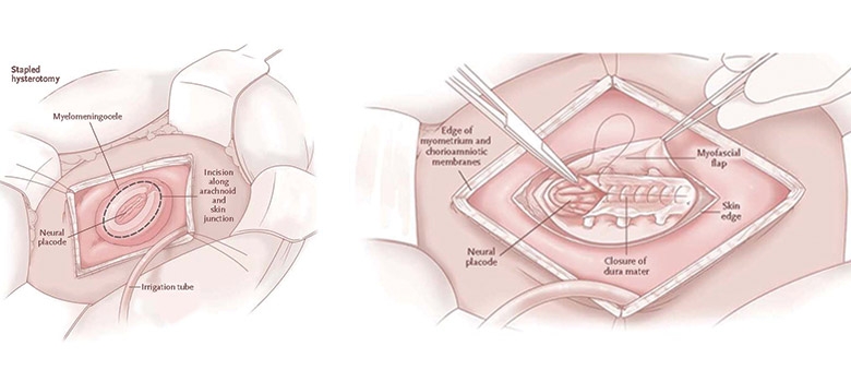 Illustration showing fetal surgery for spina bifida (myelomeningocele)
