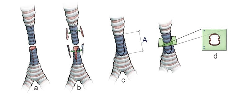 Figure 2: Slide Tracheoplasty procedure. Composite credit: Medical illustration by Brian Dunham, MD, Stream Studios at CHOP