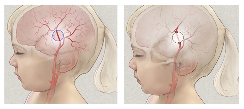 Illustration of brain with veins and arteries and circle indicating the incision area of the scalp.