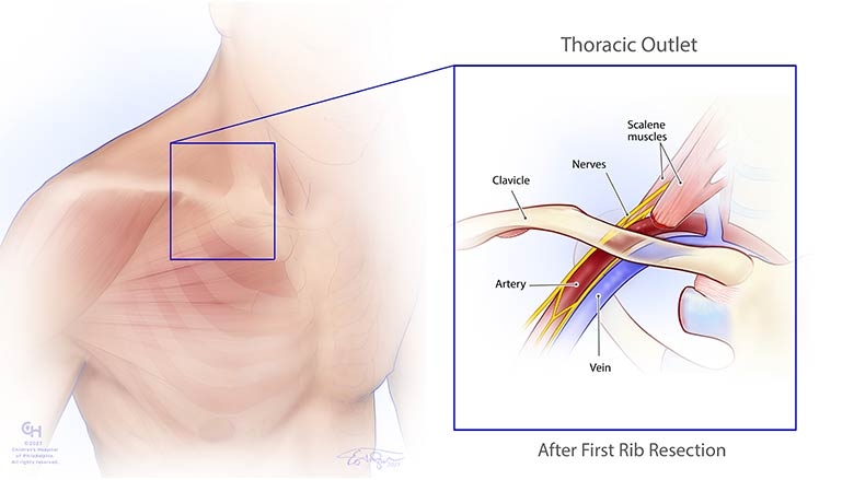 Thoracic outlet syndrome - treatment