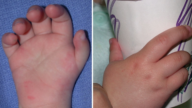 Thumb hypoplasia treated with pollicization 