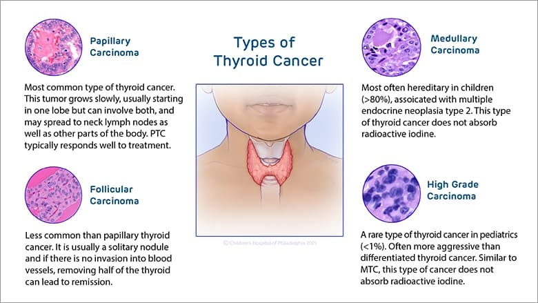 types of thyroid cancer 