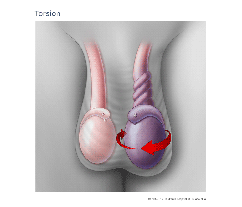 Testicular Torsion Illustration