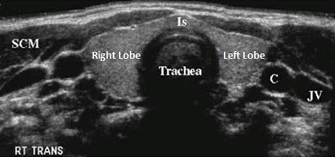 normal thyroid ultrasound image