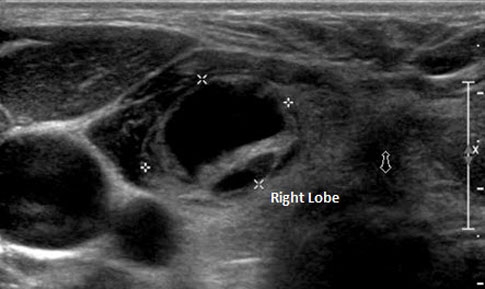 complex thyroid ultrasound image