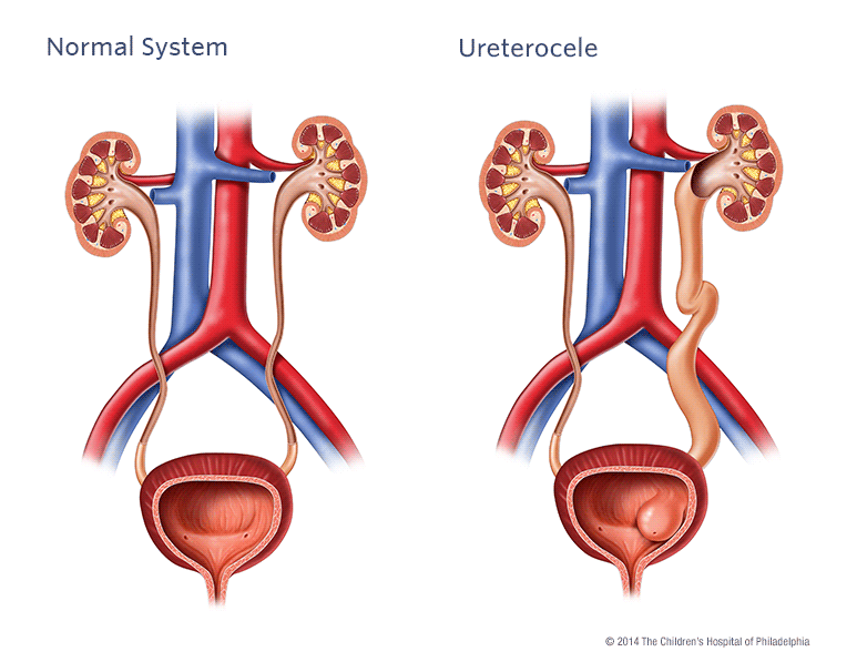 Ureterocele Illustration