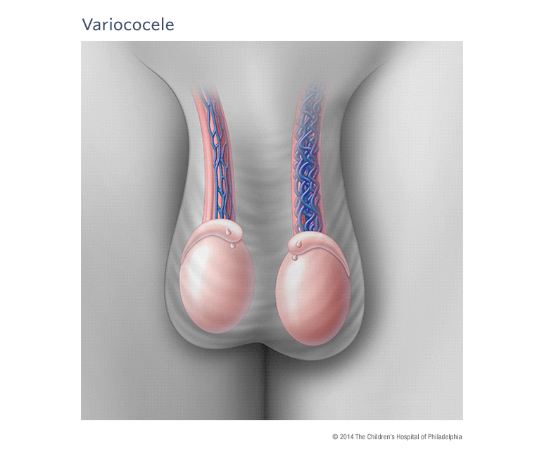 Varicocele Symptoms - irfacilities - Medium