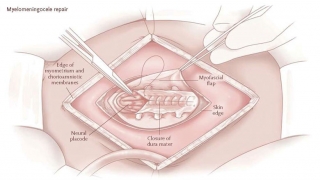 Prenatal MMC repair illustration