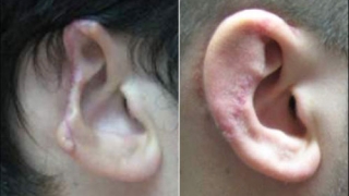 before and after view after ear reconstruction after human bite.