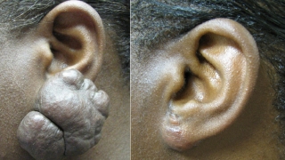 Pre-operative and post-excision of keloid and repair of earlobe.
