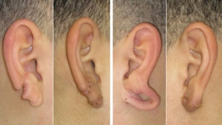 Split earlobes