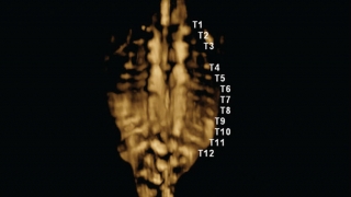 3-D ultrasound of diffuse abnormal vertebrae