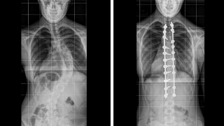 14 year old female with 65 degree thoracic idiopathic scoliosis, before and after spinal fusion using CT navigation for screw placement