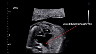 Dilated fetal heart