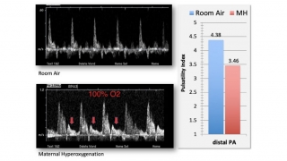 Doppler spectral display of blood flow in the right pulmonary artery under room air (top panel) and under conditions of 15 minutes of maternal hyperoxygenation (bottom panel).