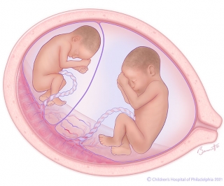 Twin-to-twin transfusion syndrome (TTTS) stage 1 illustration