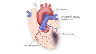 Anomalous Left Coronary Artery from the Left Pulmonary Artery Illustration