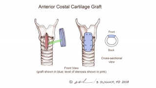 anterior costal cartilage graft
