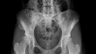 anteroposterior radiograph of pelvis