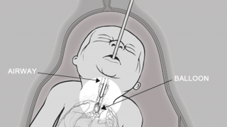 illustration of unborn baby with balloon in airway