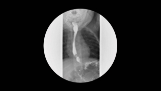 Barium Swallow Image