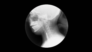 barium swallow with video