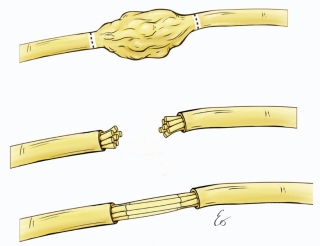 Brachial Plexus Nerve Repair Image