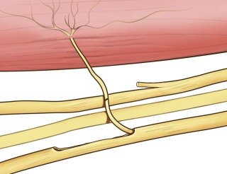 Brachial Plexus Nerve Transfer Image