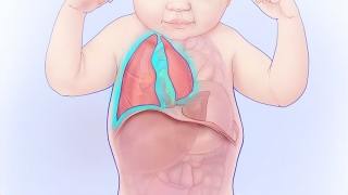 CDH illustration highlighting underdeveloped lungs