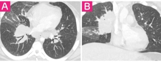 Side-by-side chest CT images