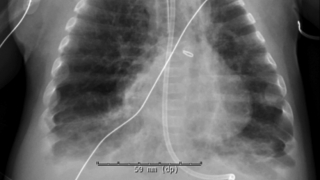 Chest X-ray Hyperinflated Right Lung