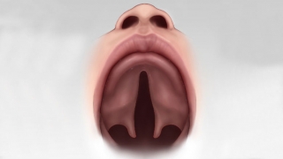 Cleft Palete view from inside mouth