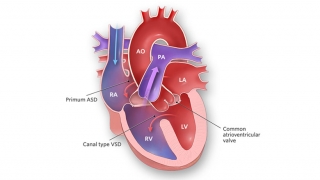 Complete Common Atrioventricular Canal Illustration