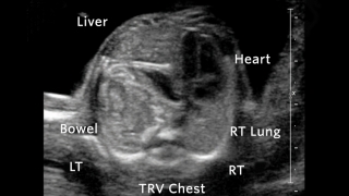 CDH Congenital Diaphragmatic Hernia Ultrasound