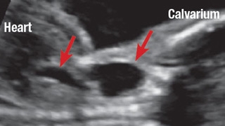 Coronal image of a fetal thymic cyst