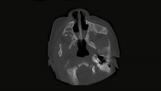 choanal atresia CT scan
