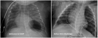 CXR image at time of admission to CHOP (L) and before NICU discharge (R)
