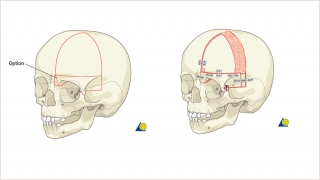 Demonstration of the bony cuts of a unilateral frontal orbital advancement
